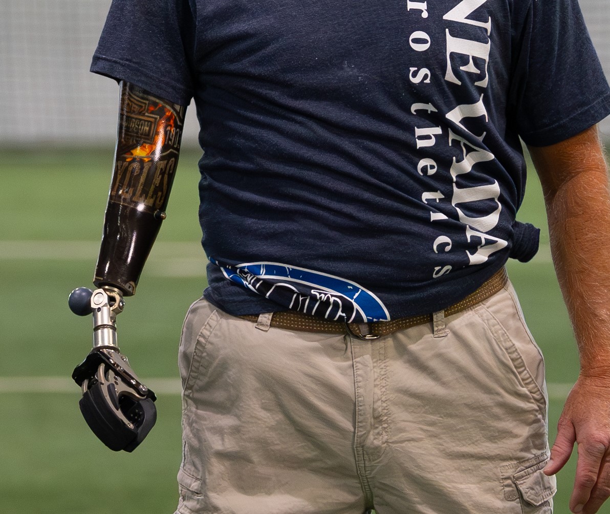 Man with prosthetic arm wearing blue shirt.